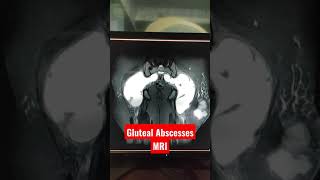 Gluteal Abscess MRI shorts shortsvideo youtubeshorts MRi Abscess [upl. by Burnie]