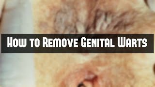 How to Remove Genital Warts [upl. by Annekcm]