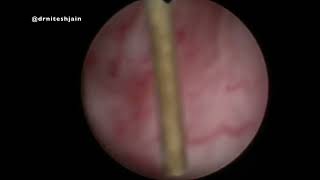 Prostatic Utricle Cyst [upl. by Lockhart866]