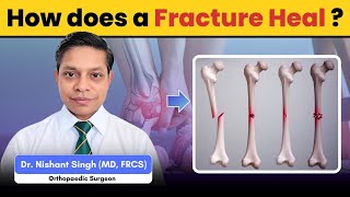 Bone fracture repair process amp What you could do to improve it [upl. by Blackburn]