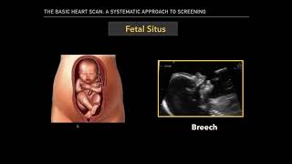 The Basic Fetal Heart Scan [upl. by Dombrowski38]