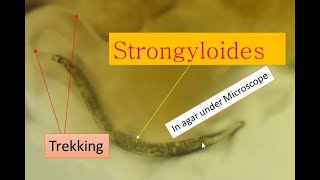 Strongyloidiasis cause and its pathogenesis Strongyloides under microscope [upl. by Elaval]