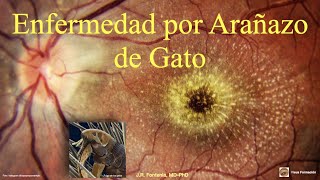 Enfermedad por Arañazo de Gato Neurorretinitis Infecciosa [upl. by Nomelihp]