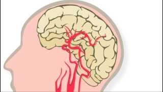 Trombolyse behandeling na een herseninfarct [upl. by Nivej]