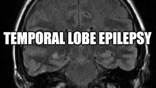 Temporal Lobe Epilepsy Seminar 2 Management [upl. by Opiuuk820]