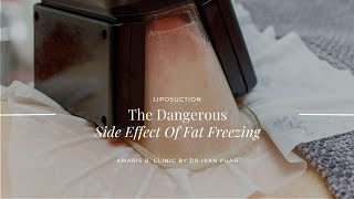 The Dangerous Side Effect Of Fat Freezing [upl. by Hinckley]