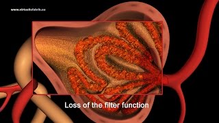 3D Animation Fokal segmental glomerulosklerose FSGS [upl. by Wier]