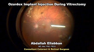 Ozurdex Implant Injection During Vitrectomy [upl. by Casady]