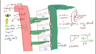 Extrahepatic biliary atresia [upl. by Mossberg]