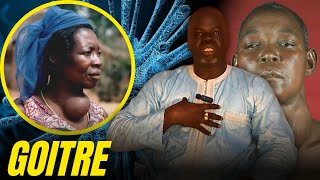 Goitre 1   Causes et Conséquences   Pr Ousmane Ndiaye  SAMA XALAAT TV [upl. by Prissie]