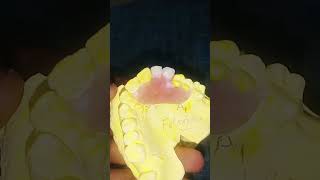 flexible partial denture by HAMZA DENTA CRAMIC and idea art orthodontist partialdenture shorts [upl. by Keli]