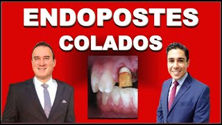 ENDOPOSTES METÁLICOS VACIADOS O COLADOS POSTES DE ENDODONCIA [upl. by Sheilah]