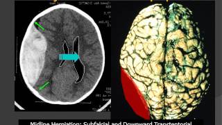 MedPix® Traumatic Brain Injury  Epidural Hematoma RadiologicPathologic Correlation [upl. by Taber]