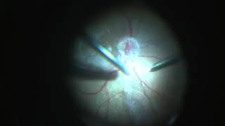 Posterior Vitreous Detachment PVD induction safe technique [upl. by Martinez]