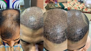 Hair transplant results in 10 days  Day by day hair transplant results [upl. by Bazil]