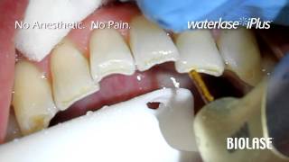 BIOLASE WaterLase iPlus Incisal Cavity Preparation [upl. by Elac]