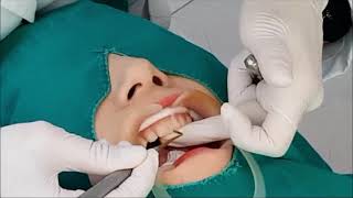 앞니레진 앞니레진 실시간 치료설명 Diastema resin closure real time anterior direct resin treatment [upl. by Ettelocin]