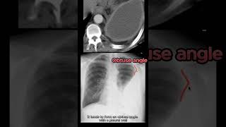 Empyema vs Pleural Effusion vs Lung Abscess radiology radiologystudent medicalstudent [upl. by Reprah268]