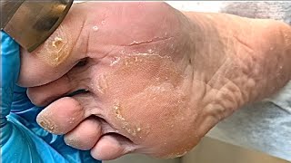 Callus removal from feetampFoot scraping dead skin【Xiao Yan pedicure】stress 19 [upl. by Nodnahs851]