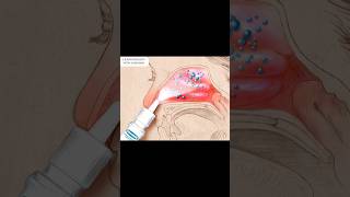 Nasonex Treatment Of Sneezing or Runny nose [upl. by Enneirda]