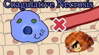 Coagulative Necrosis  Animation [upl. by Reginauld]