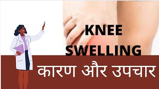 KNEE SWELLING HINDI  घुटने का दर्द कारण और उपचार  knee pain in hindi  CAUSES OF KNEE SWELLING [upl. by Inverson]