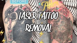 Laser Tattoo Removal  Session 1 DOES IT HURT [upl. by Karrie]