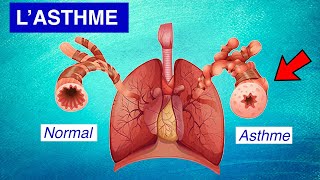 Asthme bronchique  Physiopathologie Symptômes et Traitements [upl. by Merp]