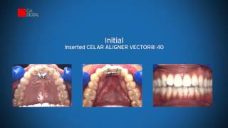 Clinical Case  CA CLEAR ALIGNER [upl. by Bois]