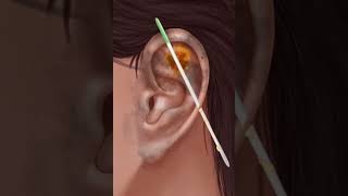 ASMR EAR  EAR TREATMENT FROM INFECTION AND ROTS  How to treat infected ear viral shorts asmr [upl. by Xed]