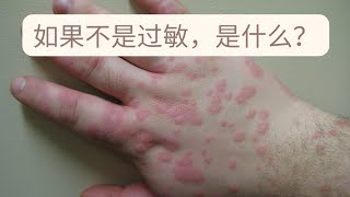 Erythema Multiforme：很像过敏的一种皮肤红疹。如何区别诊断，如何治疗，多久能好？ [upl. by Auop]