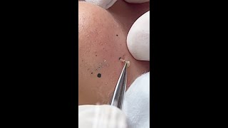 Blackhead Removal Technique on Nose Using Tweezers Deep Clean CloseUp [upl. by Kushner]