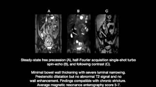 Role of Magnetic Resonance Enterography in the Management of Crohn Disease [upl. by Junji352]