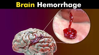 What Happens in Brain Hemorrhage  Symptoms Causes and Treatment UrduHindi [upl. by Tamara]