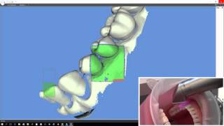 Scanner intraorale 3D Progress [upl. by Ahsiki]