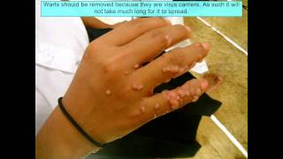 Warts on Hand  Warts on Hands Removal [upl. by Miof Mela]