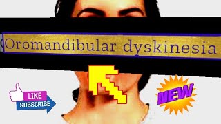 Oromandibular dyskinesia after levosulpiride [upl. by Eyar548]