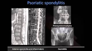 Dr Rick Chatwell Psoriatic Arthritis [upl. by Osana]