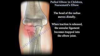 Pulled Elbow In Children Nursemaids Elbow  Everything You Need To Know  Dr Nabil Ebraheim [upl. by Nim]