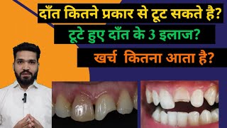 टूटे हुए दाँत के 3 इलाज और खर्च Fracture tooth treatment and cost [upl. by Brocklin116]