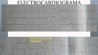 CARDIOPATIA HIPERTENSIVA Y DISFUNCION VENTRICULARwmv [upl. by Elder]