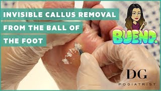 Invisible callus removal from the ball of the foot and my shoe story [upl. by Mackay]