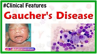 Gauchers Disease Etiology Types Clinical Features Pathogenesis Diagnosis and Treatment [upl. by Sido]