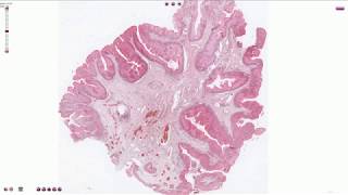 Condyloma  Histopathology [upl. by Elolcin246]