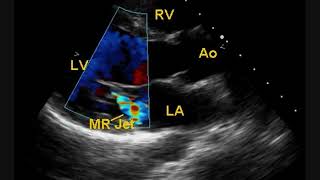 Post BMV Echocardiogram [upl. by Darb]