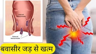 Hemorrhoids अंग्रेजी Medicine से बवासीर अब जड़ से समाप्त Piles Treatment By Allopathic Medicine [upl. by Judsen]