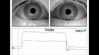 Bilateral Internuclear Ophthalmoplegia Observed in Anti–GQ1b Antibody Syndrome [upl. by Anrahs]