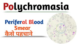 Polychromasia  Periferal blood smear [upl. by Atinas]