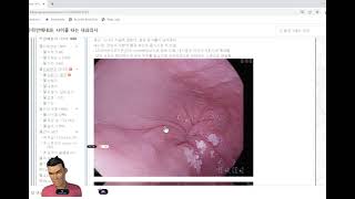 식도이완불능증 achalasia 내시경 소견  사이클타는 내과의사 우리안애내과 [upl. by Ahsienel]