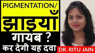 melasma treatment  pigmentation homeopathic treatment  झाइयाँ  melasma medicine [upl. by Sabir]